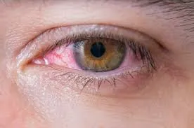 Nota sobre ¿Son los ojos rojos otro síntoma del Covid 19?